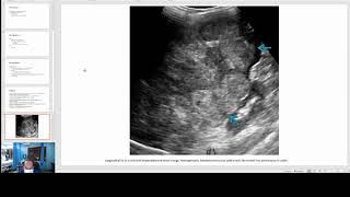 Hepatoblastoma Imaging [upl. by Dru]