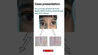 Understand the Megalocornea by a case presentation optometrists optometry optomkunj [upl. by Atileda]