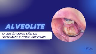 ALVEOLITE complicação PÓS OPERATÓRIA saiba quais são os sintomas e como prevenir [upl. by Liggett]