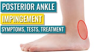 Posterior Ankle Impingement  Symptoms Diagnosis Treatment amp Recovery Time [upl. by Ethelinda]