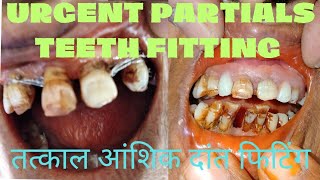 Urgent partials teeth fitting तत्काल आंशिक दांत फिटिंग  partial tooth replacement lukekahng [upl. by Gunas]