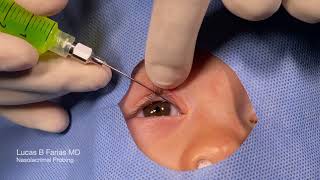 Probing of Nasolacrimal Duct with Fluorescein Irrigation [upl. by Ahsieyn257]