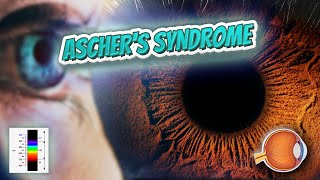 Aschers syndrome  Your EYEBALLS  EYNTK 👁️💉😳💊🔊💯✅ [upl. by Imaj]