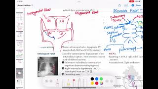 Truncus arteriosus congenitalheartdefect cardiology 52  First Aid USMLE Step 1 in UrduHindi [upl. by Nylarej382]