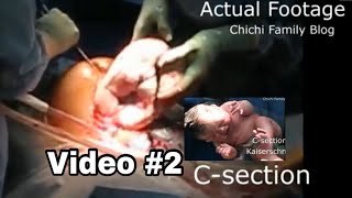 Video2 Csection Real Footage OBGYN Cesarean Delivery Surgery Kaiserschnitt Birth experience [upl. by Eendyc]