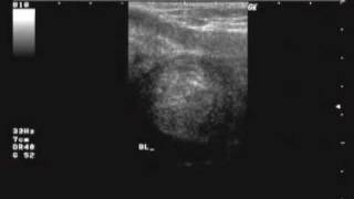 PERINEAL ULTRASOUND [upl. by Hak]