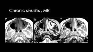 Radiology  Sinonasal imaging  Head and Neck [upl. by Aniri329]