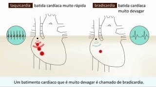 Arritmia  O que é isto [upl. by Woll739]