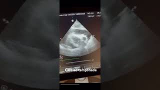 Cardiac tamponadecardiology echocardiography science medicine ultrasound [upl. by Naashar]