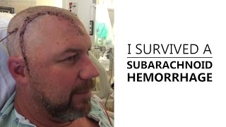 I Survived A Subarachnoid Hemorrhage [upl. by Yensehc]