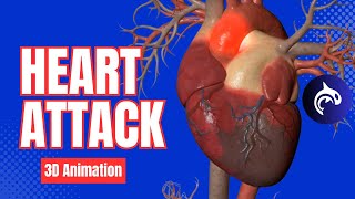 Heart Attack  Myocardial Infarction  3D Animation [upl. by Vin]