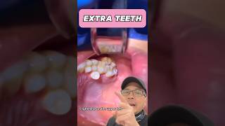 Should You Remove Your Extra Tooth Dentist EXPLAINS  View Mobile Dental shorts [upl. by Tteirrah]