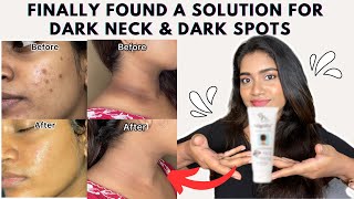 Dark neck amp Hyperpigmentation treatment  Acanthosis Nigricans treatment [upl. by Rosenblatt]