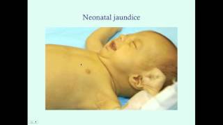 Introduction to Newborn Jaundice  CRASH Medical Review Series [upl. by Muncey]