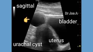 Urachal cyst ultrasound and color Doppler video [upl. by Kosey203]