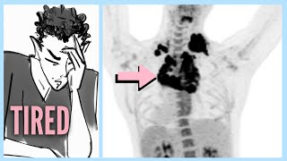 LYMPHOMA After Ignoring 6 WARNING Signs [upl. by Adnar824]