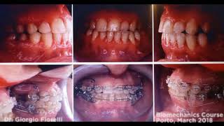 Iatrogenic Asymmetry Orthodontic case [upl. by Cheryl183]