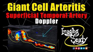 Giant Cell Arteritis  Superficial Temporal Artery Doppler  Ultrasound  Case 243 [upl. by Ahtimat]