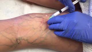 Watch This Vein Disappear  Sclerotherapy Vein Removal [upl. by Nyladam405]