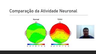 EletroEncefaloGrafia EEG de Superfície para reorientação do TDAH [upl. by Melise810]