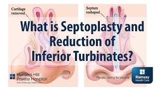 What is Septoplasty and reduction of Inferior Turbinates [upl. by Eilram]