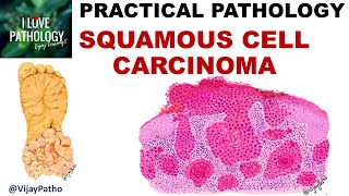 SQUAMOUS CELL CARCINOMA Clinical features amp Morphology Premalignant lesions [upl. by Andromeda]