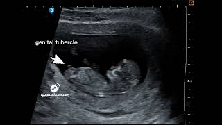 Fetal gender at 11 Weeks [upl. by Spiro]