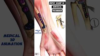 Depuy S3SNP 10 Surgical Technique Medical 3D Animation short biology With Aliya [upl. by Gran]