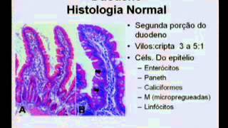 HCPA  Grand Round  Doença Celíaca [upl. by Netsreik]