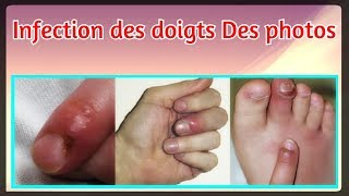 Infection des doigts Des photos [upl. by Kovar]