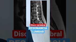 Resonancia Magnética 🧲 Lumbar 10 dolordeespalda radiologia herniadedisco 👇 [upl. by Aloise]