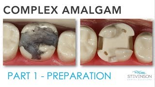 Complex Amalgam Preparation  Part 1 [upl. by Sirap]