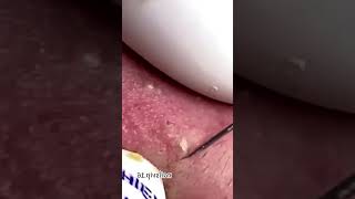 Blackheads Removal  Acne Treatment and Very Satisfying Satisfying Pimple pop blackheads [upl. by Brier]