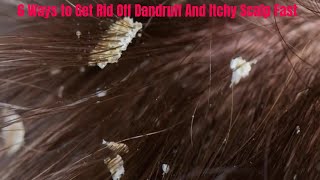 6 Home Remedies for Dandruff and Itchy Scalp for Men and Women [upl. by Ingelbert765]