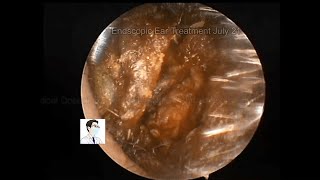 Clearance of cholesteatoma of the external auditory canal 12mins [upl. by Islean]