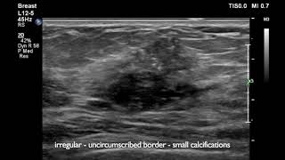 Breast Ultrasound cancer 1 [upl. by Harms407]