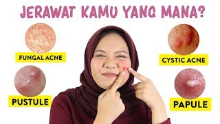 Jenis Jerawat dan Cara Mengatasinya  Skincare101 [upl. by Harald]