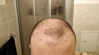 I Stopped Taking Finasteride after Hair Transplant  1 Year Hair Loss Experiment [upl. by Enened898]