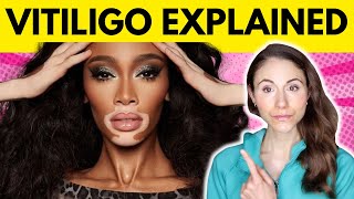 Vitiligo WHY YOU HAVE IT amp WHAT TO AVOID [upl. by Yrellam]