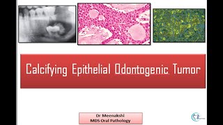 Calcifying Odontogenic Cyst  Clinical radiographic Histopathologic Features and Treatment [upl. by Eiuqcaj735]