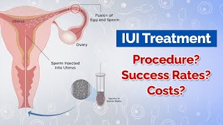 IUI Treatment Procedure Costs Success Rates [upl. by Aivatnahs]