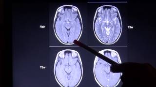 Grundlagen und Unterscheidungsmerkmale zu wichtigen MRT Sequenzen [upl. by Hitt]