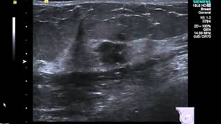 Breast Ultrasound cancer 2 [upl. by Droc]