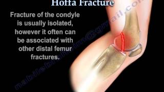 Hoffa Fracture  Everything You Need To Know  Dr Nabil Ebraheim [upl. by Spancake970]