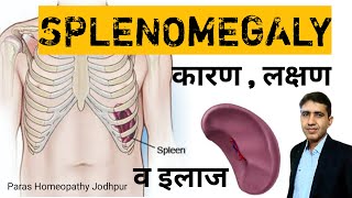 Splenomegaly  तिल्ली बढ़ना  Enlarged Spleen in Hindi  Spleen Enlargement Homeopathic Treatment [upl. by Chatterjee]