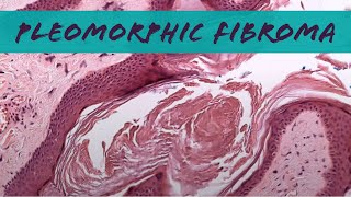 Pleomorphic fibroma looks like skin tag but relative of spindle cellpleomorphic lipoma pathology [upl. by Engeddi]