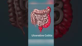 Understanding Crohns Disease vs Ulcerative Colitis [upl. by Hunley]