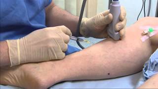 Foam sclerotherapy for varicose veins  Philip Coleridge Smith [upl. by Eidnil]