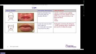 Contact Dermatitis and Patch Testing Fonacier [upl. by Prager]