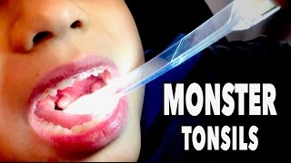 MONSTER TONSILS  Abscess Tonsillitis  Dr Paul [upl. by Hernando]